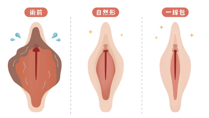 一線鮑術前術後示意圖
